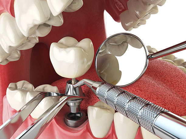 Best Emergency Tooth Extraction in Dover, FL